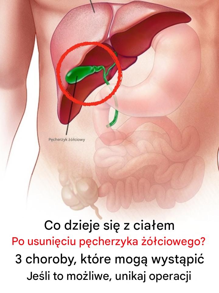 Co dzieje się z organizmem po usunięciu pęcherzyka żółciowego? 3 choroby, które mogą nastąpić – unikaj operacji, jeśli to możliwe