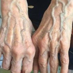 Widoczne żyły – co oznaczają i dlaczego możesz je zauważyć