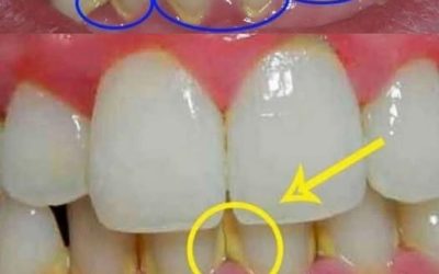 Usuń płytkę nazębną w naturalny sposób w 5 minut, bez konieczności wizyty u dentysty.