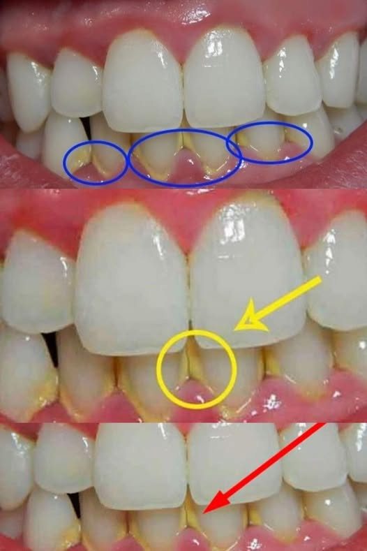 Usuń płytkę nazębną w naturalny sposób w 5 minut, bez konieczności wizyty u dentysty.