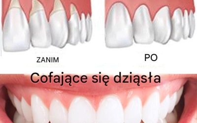 Choroba dziąseł: cichy zabójca. 8 domowych sposobów na naturalne jej wyleczenie