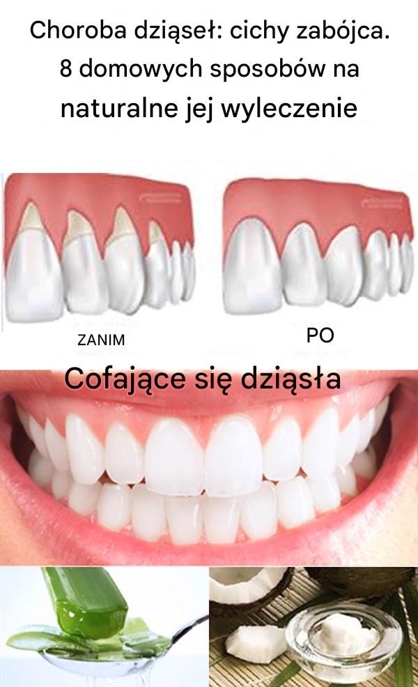 Choroba dziąseł: cichy zabójca. 8 domowych sposobów na naturalne jej wyleczenie