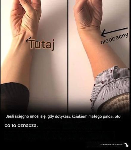 Jeśli ścięgno unosi się, gdy dotykasz kciukiem małego palca, oto co to może oznaczać.