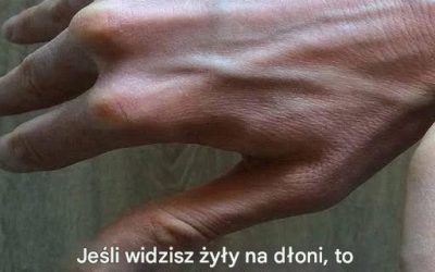 Widoczne żyły – wyjaśnienie: typowe przyczyny, zagrożenia dla zdrowia i kiedy należy się martwić.