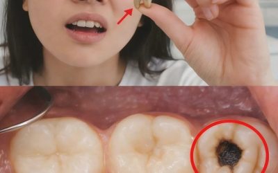 Jak naturalnie wyleczyć próchnicę. Pamiętaj o tych wskazówkach, aby uniknąć wizyty u dentysty.
